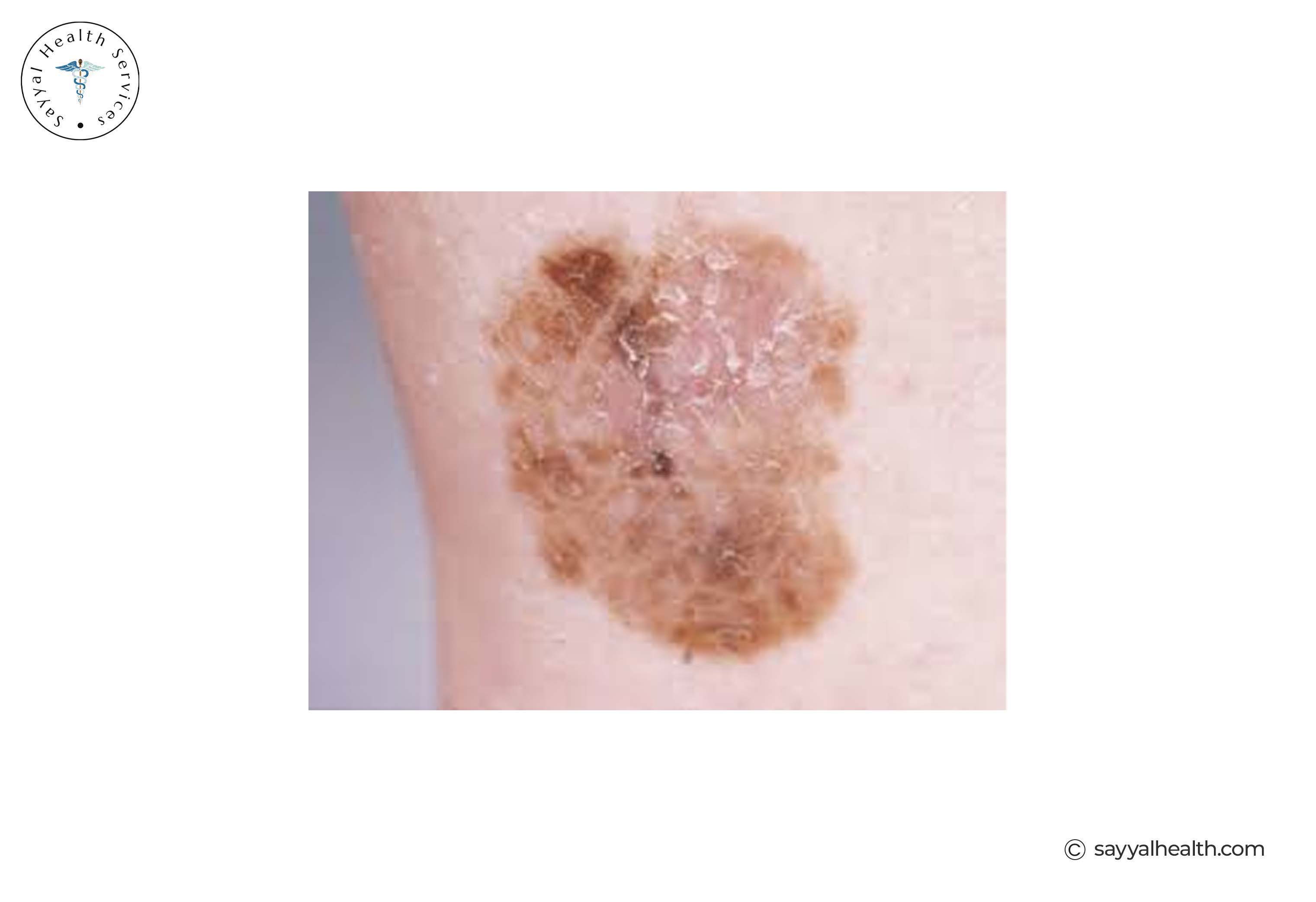 pictures of superficial spreading melanoma
